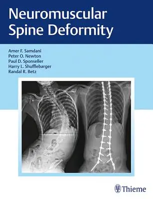 Deformità neuromuscolare della colonna vertebrale - Neuromuscular Spine Deformity