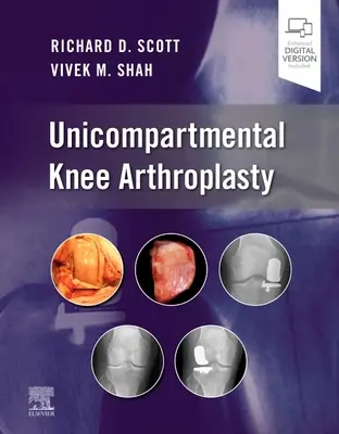 Artroplastica monocompartimentale del ginocchio - Unicompartmental Knee Arthroplasty