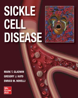 Malattia delle cellule falciformi - Sickle Cell Disease