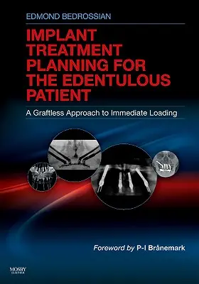 Pianificazione del trattamento implantare per il paziente edentulo: Un approccio senza innesto al carico immediato - Implant Treatment Planning for the Edentulous Patient: A Graftless Approach to Immediate Loading