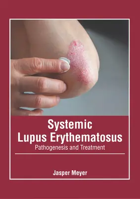 Lupus eritematoso sistemico: Patogenesi e trattamento - Systemic Lupus Erythematosus: Pathogenesis and Treatment