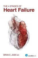 Le 4 fasi dell'insufficienza cardiaca - The 4 Stages of Heart Failure