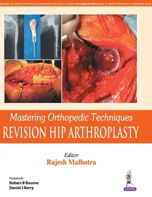 Mastering Orthopedic Techniques: Artroplastica totale di revisione dell'anca - Mastering Orthopedic Techniques: Revision Total Hip Arthroplasty
