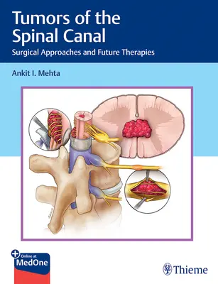 Tumori del canale spinale: Approcci chirurgici e terapie future - Tumors of the Spinal Canal: Surgical Approaches and Future Therapies