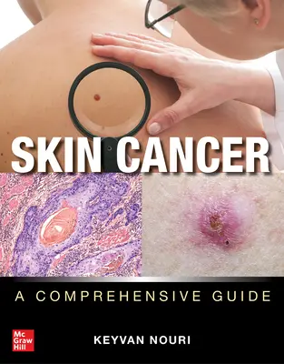 Cancro della pelle: Una guida completa - Skin Cancer: A Comprehensive Guide