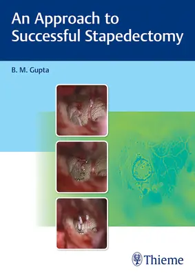 Un approccio al successo della stapedectomia - An Approach to Successful Stapedectomy