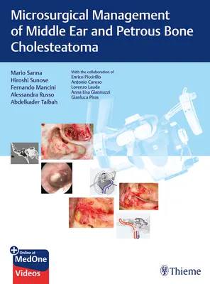 Gestione microchirurgica del colesteatoma dell'orecchio medio e dell'osso petroso - Microsurgical Management of Middle Ear and Petrous Bone Cholesteatoma