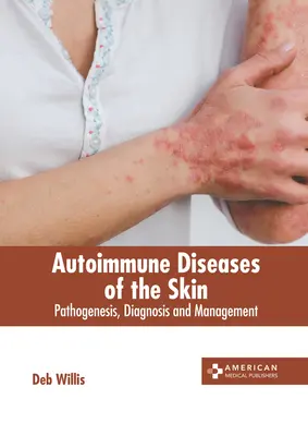 Malattie autoimmuni della pelle: Patogenesi, diagnosi e gestione - Autoimmune Diseases of the Skin: Pathogenesis, Diagnosis and Management