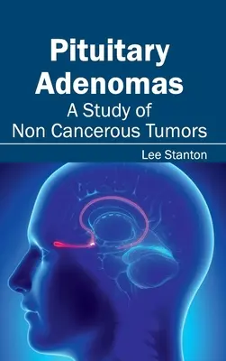 Adenomi ipofisari: Uno studio sui tumori non cancerosi - Pituitary Adenomas: A Study of Non Cancerous Tumors