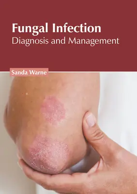 Infezioni fungine: Diagnosi e gestione - Fungal Infection: Diagnosis and Management