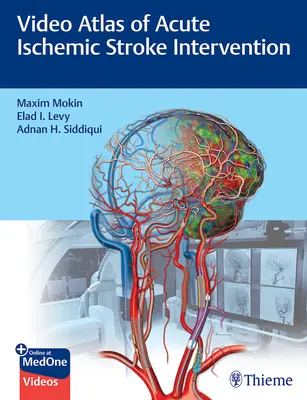 Atlante video dell'intervento sull'ictus ischemico acuto - Video Atlas of Acute Ischemic Stroke Intervention