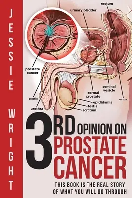 Il terzo parere sul cancro alla prostata - 3rd Opinion on Prostate Cancer