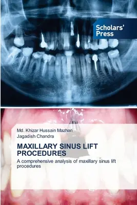 Procedure di lifting del seno mascellare - Maxillary Sinus Lift Procedures