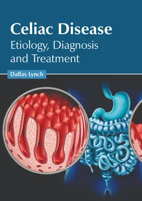 Celiachia: Eziologia, diagnosi e trattamento - Celiac Disease: Etiology, Diagnosis and Treatment