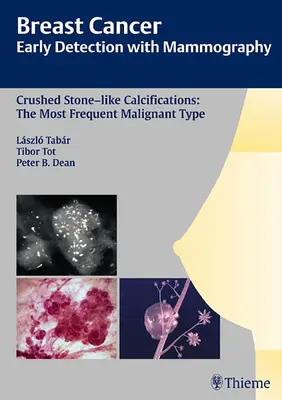 Cancro al seno: Diagnosi precoce con la mammografia: Calcificazioni simili a pietre schiacciate: Il tipo maligno più frequente [Con CDROM]. - Breast Cancer: Early Detection with Mammography: Crushed Stone-Like Calcifications: The Most Frequent Malignant Type [With CDROM]