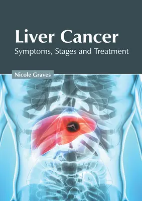 Cancro al fegato: Sintomi, stadi e trattamento - Liver Cancer: Symptoms, Stages and Treatment