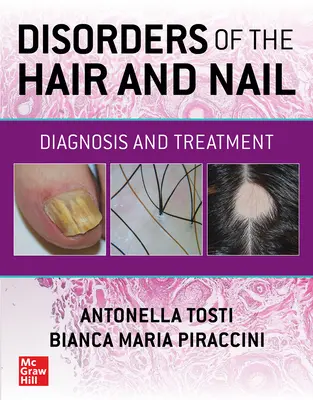 Disturbi dei capelli e delle unghie: Diagnosi e trattamento - Disorders of the Hair and Nail: Diagnosis and Treatment