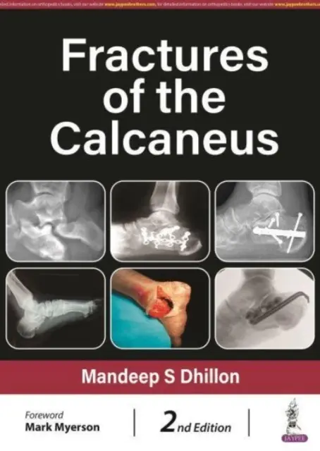 Fratture del calcagno - Fractures of the Calcaneus